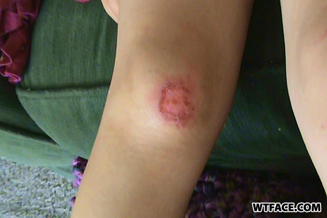 Lilys_knee_3e